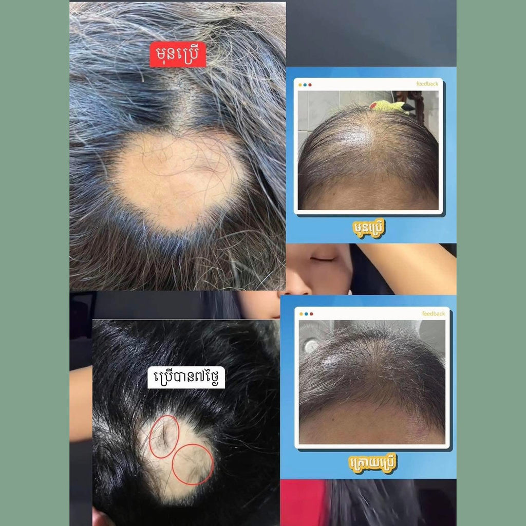 សក់មានសំណើម កំចាត់អង្គែ បណ្តុះសក់ថ្មី