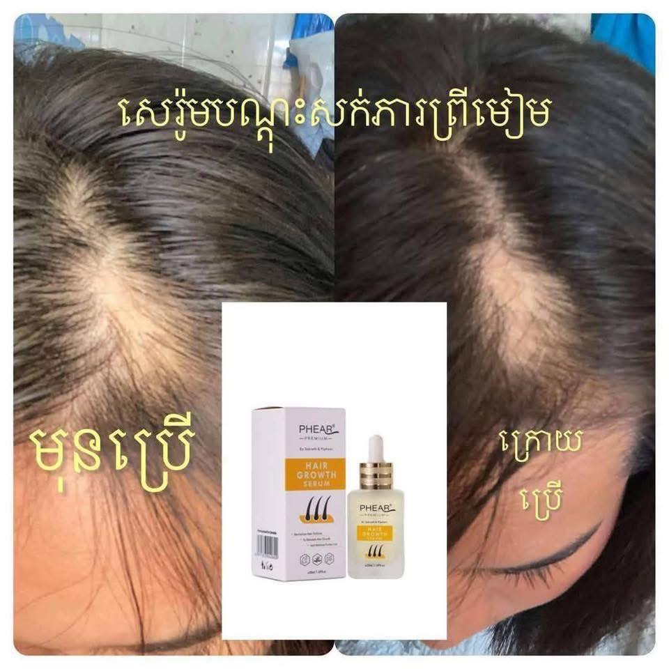 បណ្តុះសក់ថ្មី សក់ជ្រុះខ្លាំង អង្គែរមាស់ ប្រេង