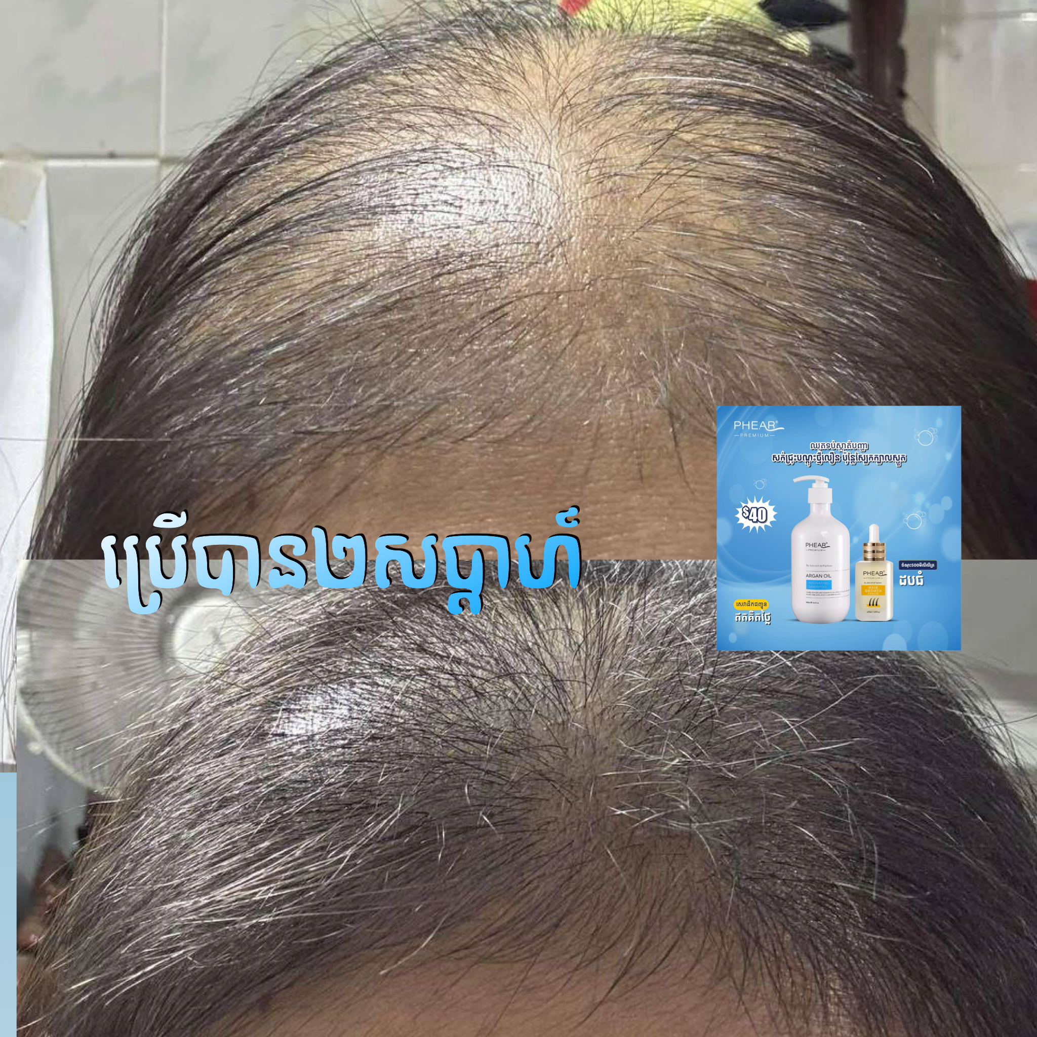 បណ្តុះសក់ថ្មី សក់ជ្រុះខ្លាំង អង្គែរមាស់ ប្រេង