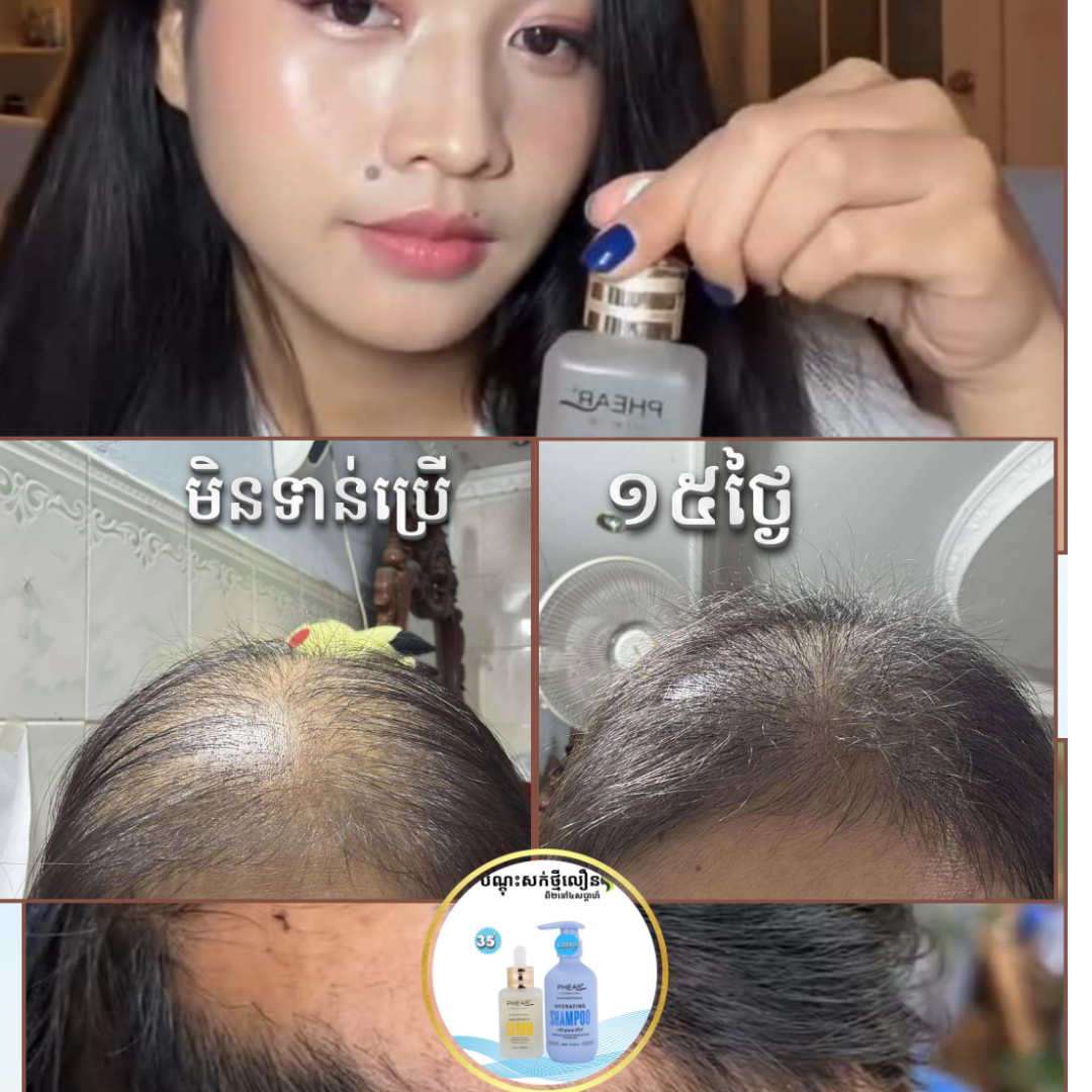 បងស្រីជ្រុះសក់ស្ទើរអស់ពីក្បាល ប្រើសេរ៉ូំមបាន២សប្តាហ៌ សក់ដុះវិញប៉ុណ្ណឹង